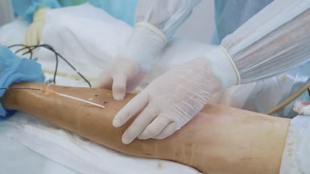 Крупним планом руки лікаря в стерильних рукавичках роблять операцію з видалення варикозного розширення вен на нозі пацієнта — стокове відео