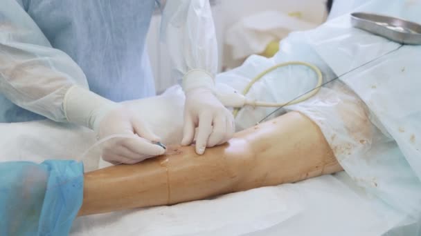 Cirurgião de perto insere uma agulha médica na perna do paciente durante uma operação de escleroterapia — Vídeo de Stock