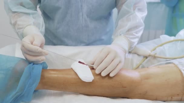 Närbild kirurg infogar en medicinsk nål i patientens ben under en scleroterapi operation — Stockvideo