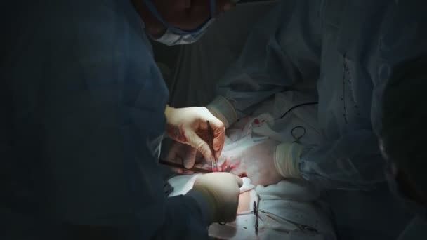 Close-up van chirurgen maken chirurgie met open wond bij de maag. Artsen gebruiken medische scalpel en klem — Stockvideo