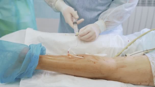 Close up Doctor doet een echografie op de patiënt been voordat Sclerotherapie procedure in operatiekamer — Stockvideo