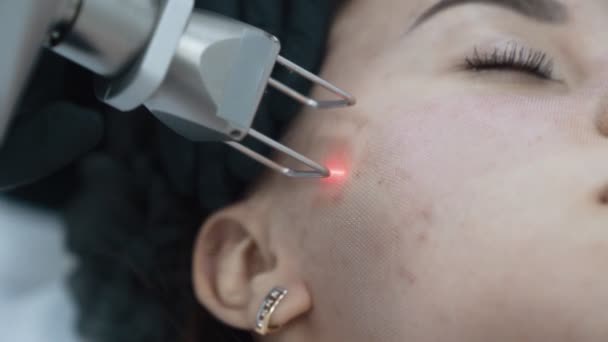 Close up parte della faccia giovane donna sulla procedura di peeling laser, rallentatore — Video Stock