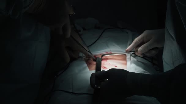 Close-up surgeons hands make surgery to patient with special instruments, slow motion — Stock Video