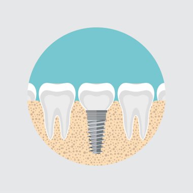 bir insan diş implantı, diş kavramının anatomisi. Diş kökü kanalı. diş rengi görüntü, diş hekimliği düz tarzı, diş hekimliği tasarımı, Diş illüstrasyon, yenilikçi teknoloji diş tasvir ile boyama