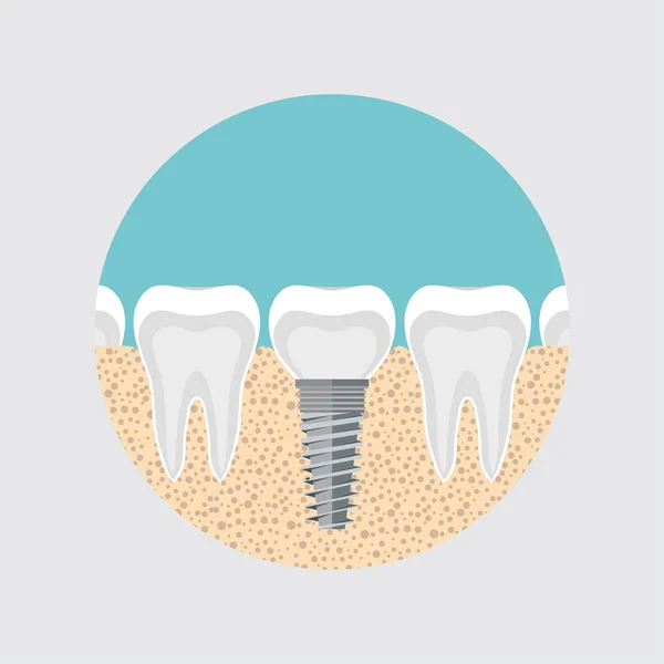 implant of a human tooth, anatomy of the tooth concept. Dental root canal. image of tooth color, flat style of dentistry, dentistry design, Dental illustration, painting with innovative technology depicting teeth