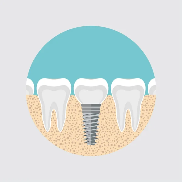 Implantat Eines Menschlichen Zahnes Anatomie Des Zahnkonzepts Zahnwurzelkanal Vektorbild Der — Stockvektor