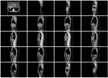 CT taraması adım set vücut sagittal görünümü