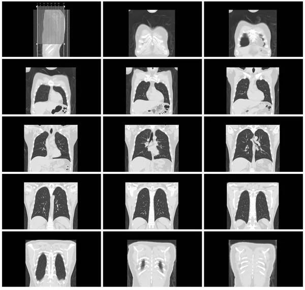 Taraması Adım Set Vücut Akciğer Koronal Görünümü — Stok fotoğraf