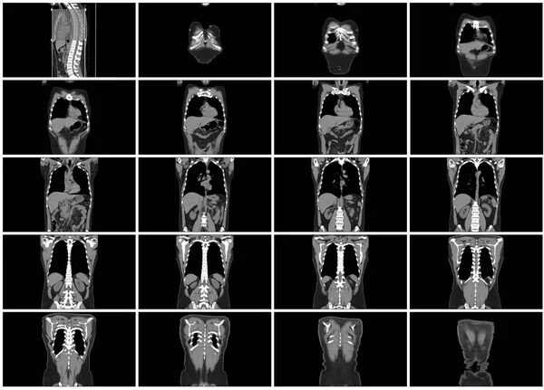 Taraması Adım Set Vücut Koronal Görünümü — Stok fotoğraf