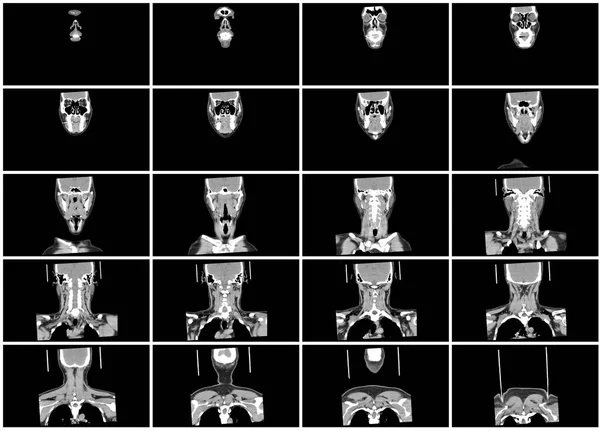 Taraması Adım Kümesi Boyun Koronal Görünümü — Stok fotoğraf
