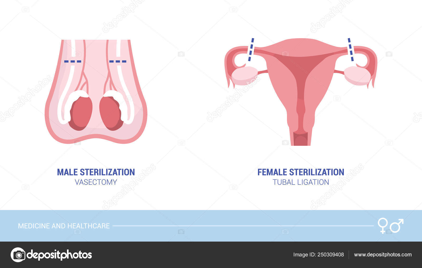 Male Female Sterilization Procedures Vasectomy Tubal Ligation Healthcare  Birth Control Stock Vector Image by ©elenabs #250309408