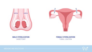 Erkek ve dişi sterilizasyon prosedürleri: kısırlaştırma ve tubal ligasyon, sağlık ve doğum kontrol kavramı