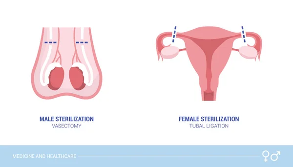 Procedimientos Esterilización Masculina Femenina Vasectomía Ligadura Trompas Cuidado Salud Concepto — Vector de stock