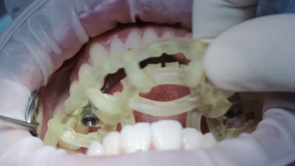 Шаблон с рукавами для прямой имплантации зубов — стоковое видео