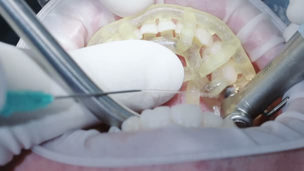 Proces rekonstrukce prsu implantáty — Stock video