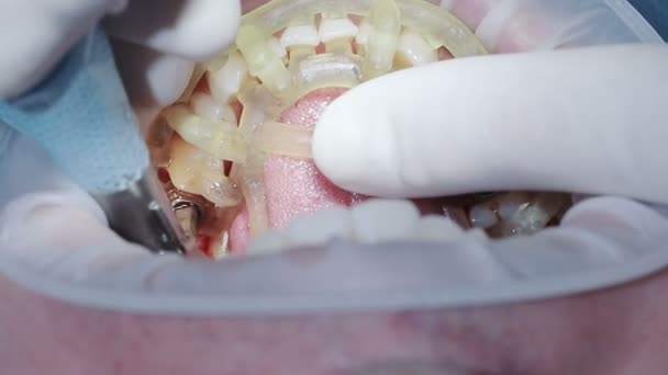 Nahaufnahme bei der Installation des Implantats des Zahnes — Stockvideo