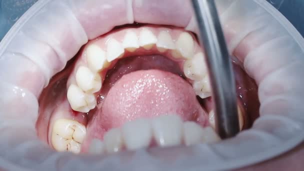 Funzionamento sull'installazione dell'impianto del dente. Primo piano del cranio umano — Video Stock