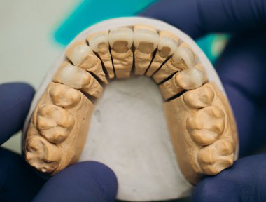 Seramik diş diş kron modeli. Seramik açık kaplama.