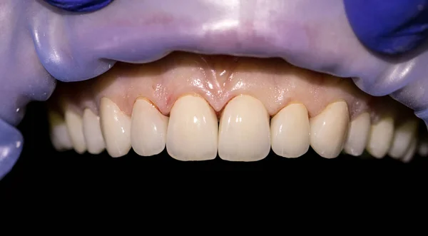 Finished ceramic front crowns, black background. 8 units dental veneers — Stock Photo, Image