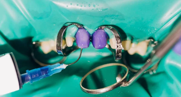 Chapas dentales. Coronas delanteras de cerámica, fondo verde — Foto de Stock