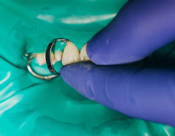 Colocação de folheados dentários. Coroas dianteiras de cerâmica, fundo verde — Fotografia de Stock