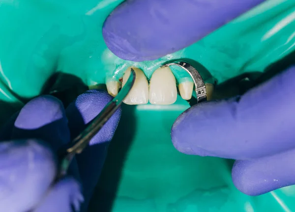 Colocación de chapas dentales. Coronas delanteras de cerámica, fondo verde. 8 unidades de chapas dentales — Foto de Stock
