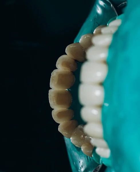 Keramische front kronen, groene achtergrond. 8 eenheden tandheelkundige fineer — Stockfoto