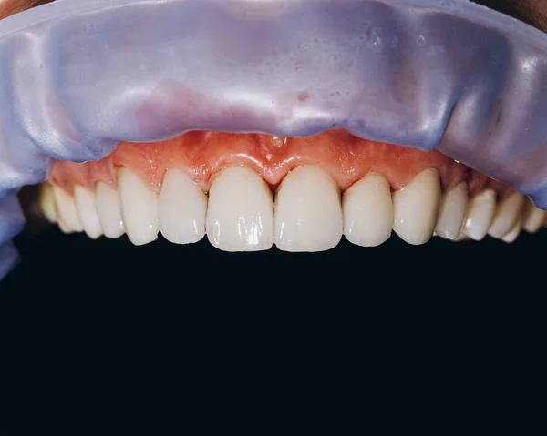 Acabado coroas dianteiras de cerâmica, fundo preto. 8 unidades folheados dentários — Fotografia de Stock