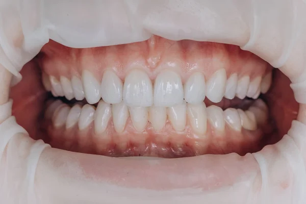 Acabado coronas delanteras de cerámica. 8 unidades de chapas dentales . — Foto de Stock