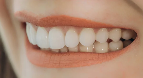 Acabado Coroas Dianteiras Cerâmica Unidades Folheados Dentários — Fotografia de Stock