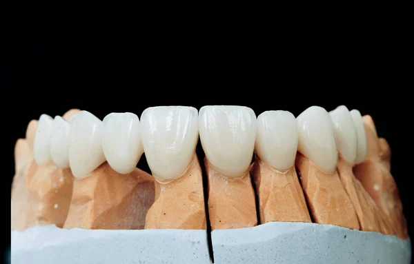 Siyah bir arka plan üzerinde izole bir alçı modeli üzerinde implant ile seramik dişler. Zirkonyum taçlar