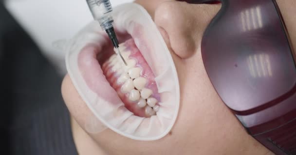 Mujer joven con un expansor en la boca en la clínica dental. Hermosa sonrisa. La salud de los dientes. Estomatólogo dentista blanqueamiento de dientes para el paciente en la clínica dental de medicina — Vídeos de Stock