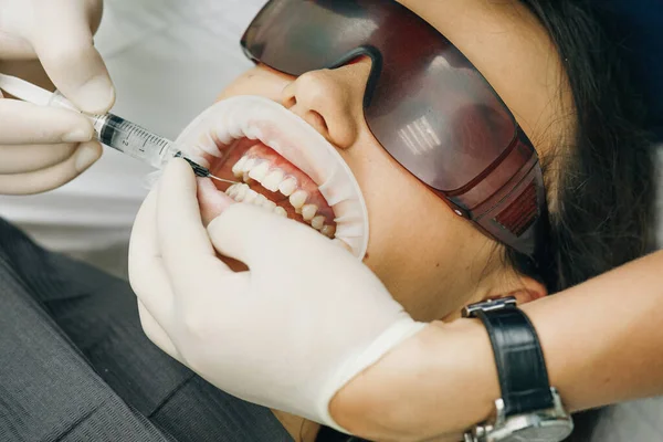 Aplicação de gel clareador protetor para os dentes. Mulher com um expansor na boca na clínica dentária. Belo sorriso. A saúde dos dentes. Dentista estomatologista clareamento dos dentes para o paciente . — Fotografia de Stock