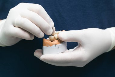 Diş implantlarının protezleri. Ortopedik dişçilik kavramı. İmplantlarda seramik köprü. Dişçilerin elleri alçıdan bir çene ve diş tabanı tutar. Sıva modeline takılmış seramik dişler.