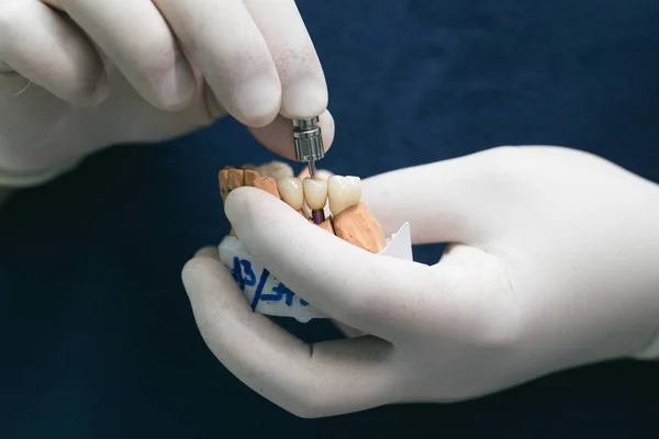 Dentes cerâmicos com o implante em um modelo de gesso. Prótese sobre implantes dentários. Conceito de odontologia ortopédica. Ponte de cerâmica sobre implantes. Dentistas mão segura uma mandíbula de gesso com pilares dentários — Fotografia de Stock