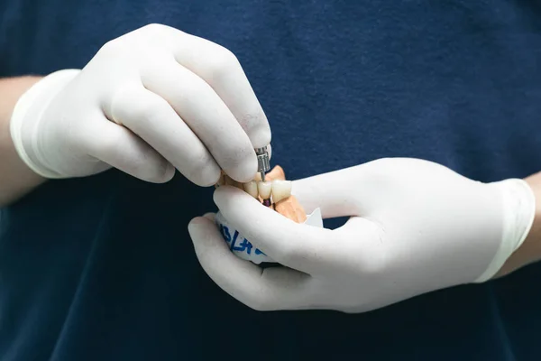 Keramische Brücke auf Implantaten. Die Hand des Zahnarztes hält einen Gipskiefer mit Abutments. Keramische Zähne mit Implantat auf einem Gipsmodell — Stockfoto
