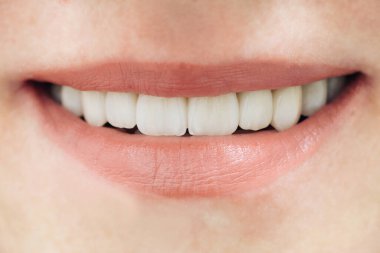 Beautiful female teeth macro zirconium. Closeup smile photo with zirconium artificial teeth. Zirconia bridge with porcelain. clipart