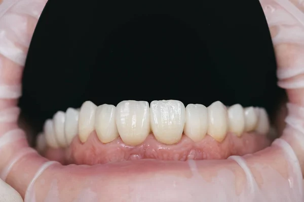 Foto de primer plano con dientes artificiales de circonio. Coronas de circonio —  Fotos de Stock