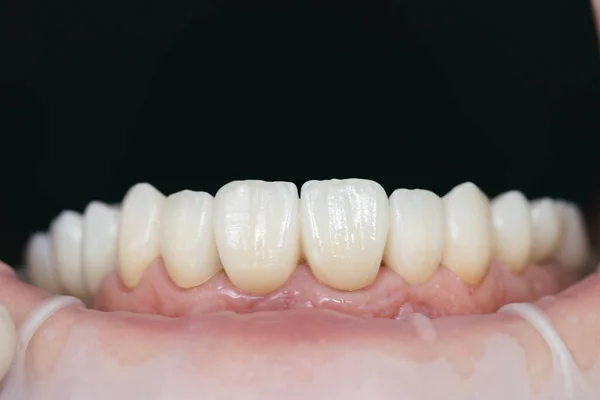 Tandheelkundige gezondheidszorg. Keramische zirkonium in definitieve versie. Kleuring en beglazing. Precisieontwerp en hoogwaardige materialen — Stockfoto