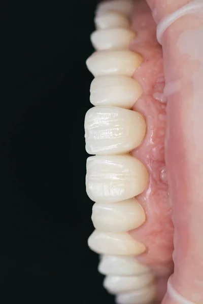 Circonio cerámico en versión final. Mancha y acristalamiento. Diseño de precisión y materiales de alta calidad. Atención de la salud dental — Foto de Stock