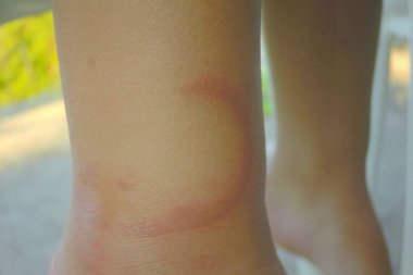 jöle balık , denizanası yara ısırık çocuğun bacağında. Pelagia noctiluca ısırığı.