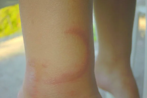 Jelly fish ,jellyfish wound bite on child's leg. Pelagia noctiluca bite. — Stock Photo, Image