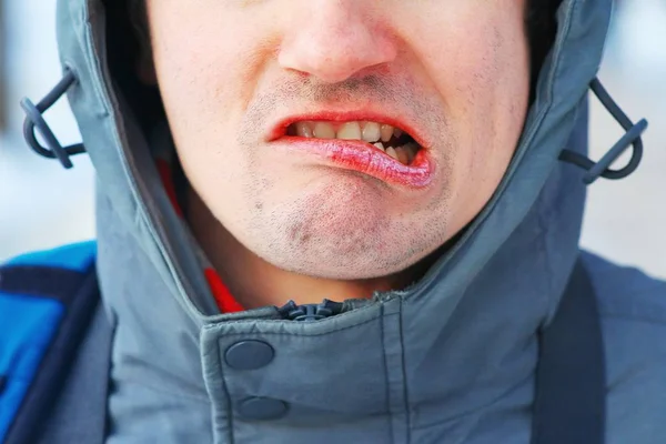 Popękane Suche Usta Twarz Mężczyzny Twarz Mężczyzny Contorts Bólu Suchość — Zdjęcie stockowe