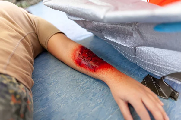 First Aid Bandage Burnt Wound Victim — Stock Photo, Image
