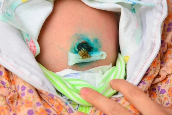 Ombligo Bebé Recién Nacido Cordón Umbilical Tratado Con Pintura Verde — Foto de Stock
