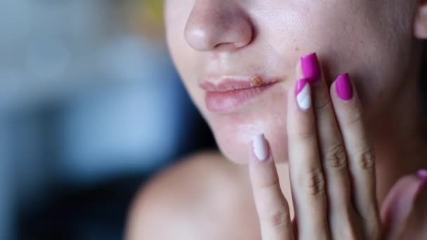 Ragazza Che Tocca Piaghe Herpes Sulle Labbra Trattamento Delle Labbra — Video Stock