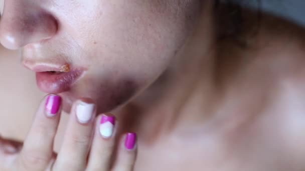 Młoda Kobieta Skórą Problematyczną Dotykając Rany Opryszczka Spierzchnięte Usta Koncepcja — Wideo stockowe