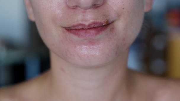 年轻女子皮肤有问题 接触疱疹的疮 嘴唇骨折 唇部处理理念 — 图库视频影像
