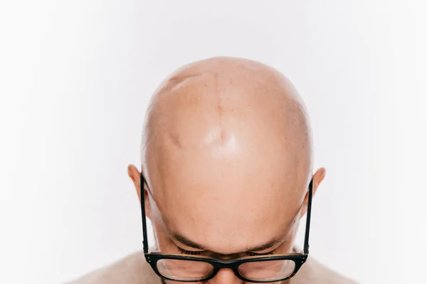 Visão Parcial Homem Careca Após Cirurgia Neurocirurgia Oncológica — Fotografia de Stock