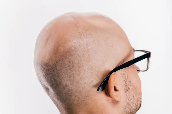 Gedeeltelijke Weergave Van Kale Man Kanker Neurochirurgie Operatie — Stockfoto